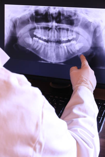 Emergency Dental Filling Replacement in GA